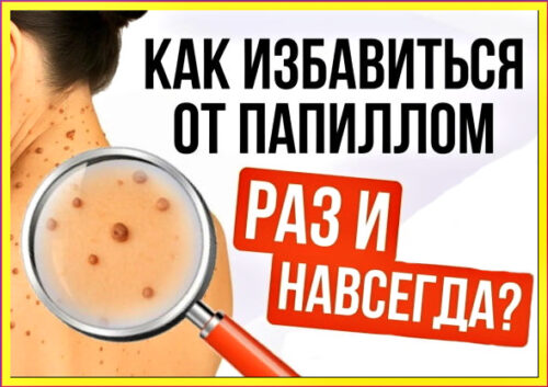 Папилломы